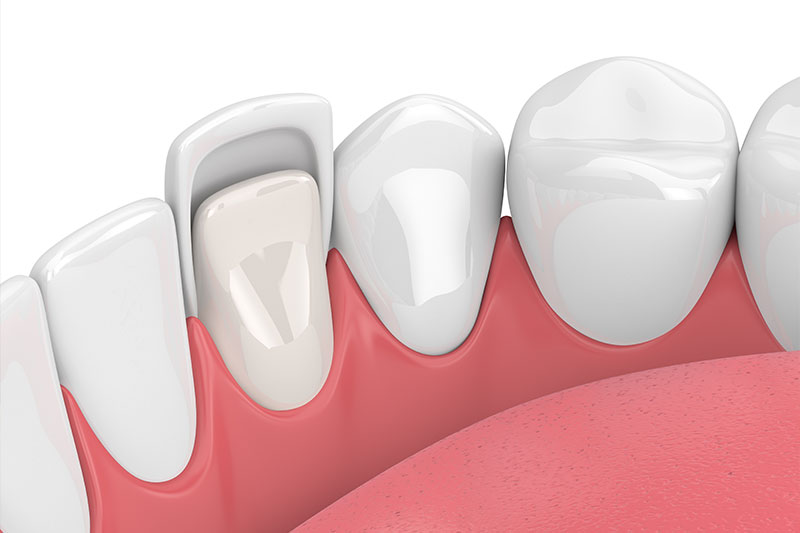 Porcelain Veneers in Dumfries