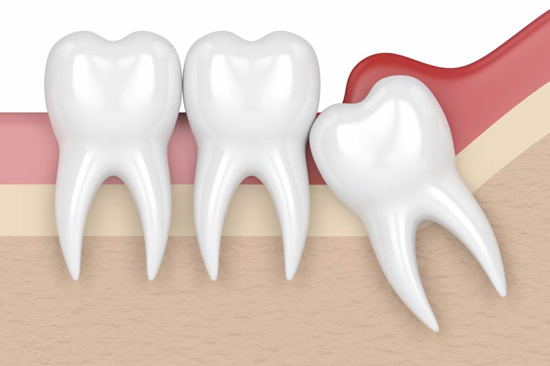 Wisdom Tooth Removal in Dumfries